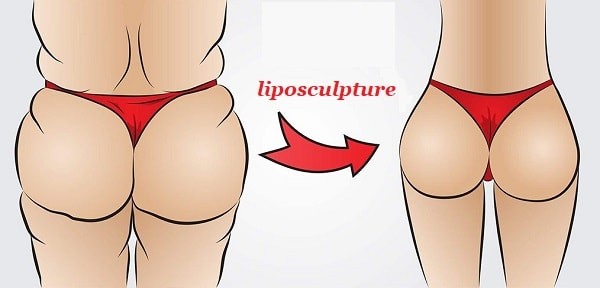 Липоскульптурирование — уверенный шаг к совершенному телу Липоскульптурирование — уверенный шаг к совершенному телу