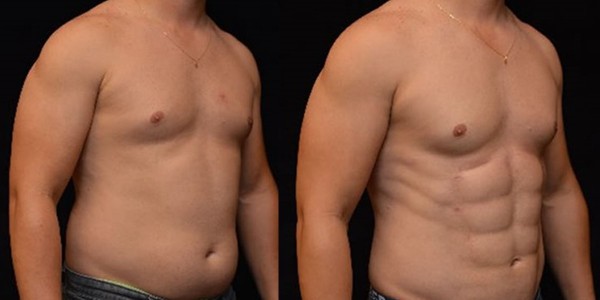 Липоскульптурирование — уверенный шаг к совершенному телу Липоскульптурирование — уверенный шаг к совершенному телу